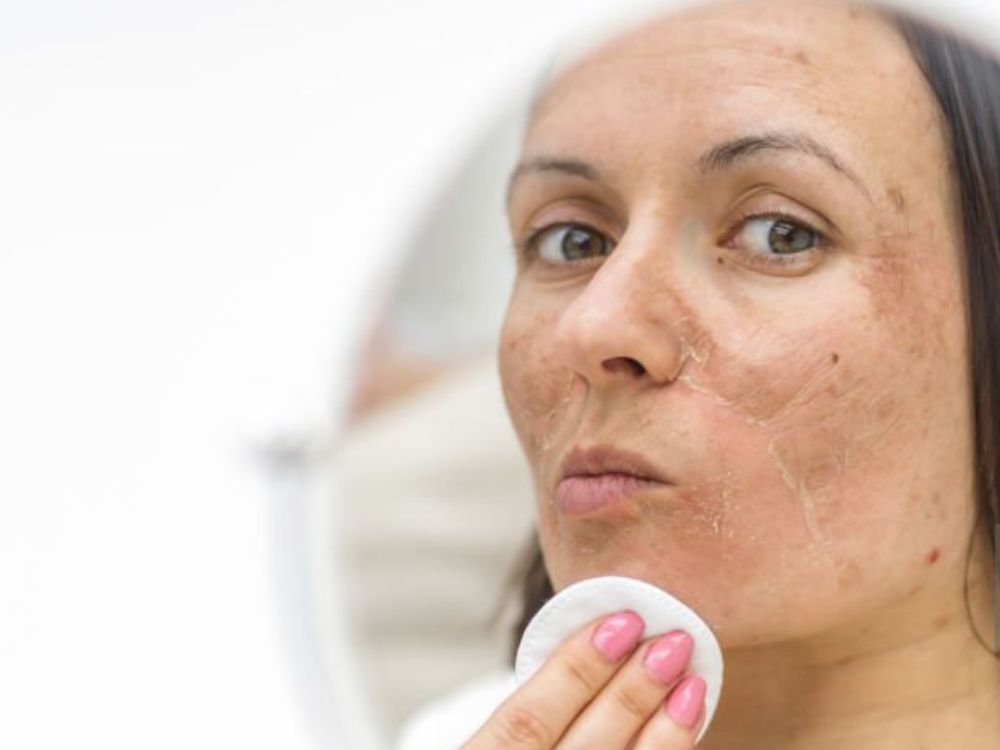 Embora não haja cura para essas manchas, existem muitas opções de tratamento disponíveis, incluindo peelings químicos.
